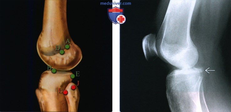 Признаки отрывной травмы колена