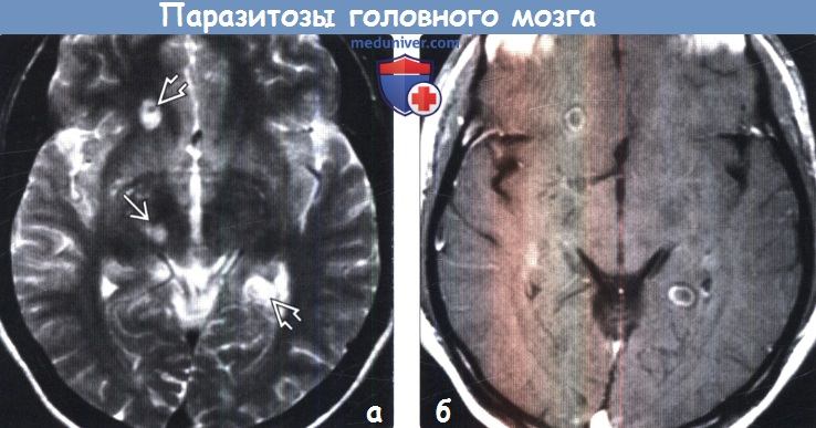 Паразитозы головного мозга на МРТ