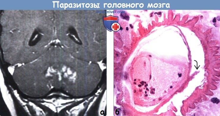 Паразитозы головного мозга на МРТ, макропрепаратах