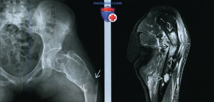 Признаки патологического перелома кости