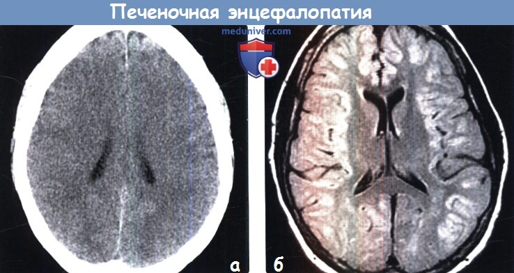 Печеночная энцефалопатия на МРТ головного мозга