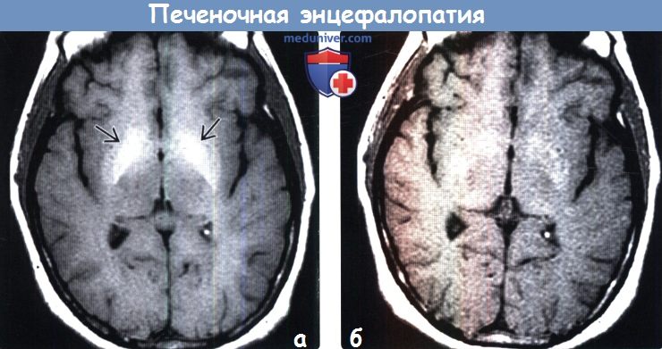 Печеночная энцефалопатия на МРТ головного мозга