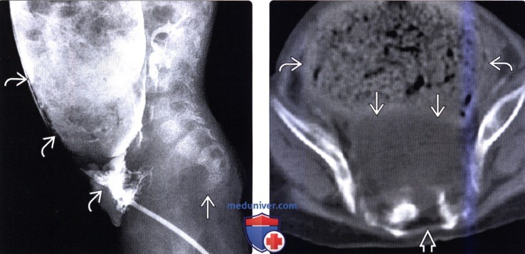 Рентгенограмма, КТ при переднем крестцовом менингоцеле