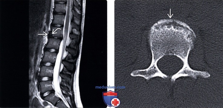 МРТ перелома апофизарного кольца позвонка