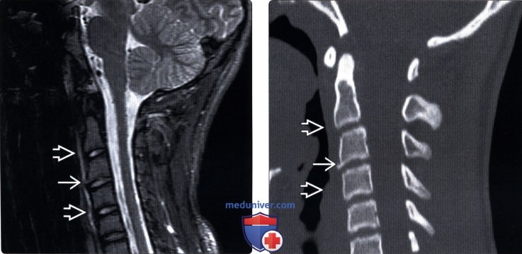 МРТ перелома апофизарного кольца позвонка
