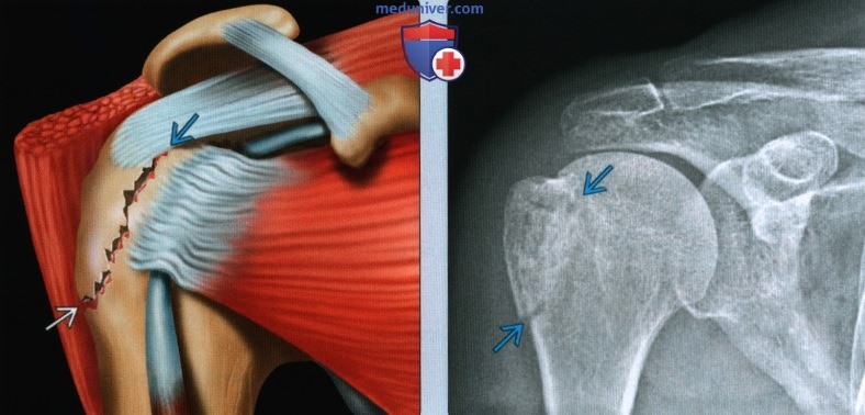 Признаки перелома большого бугорка плечевой кости