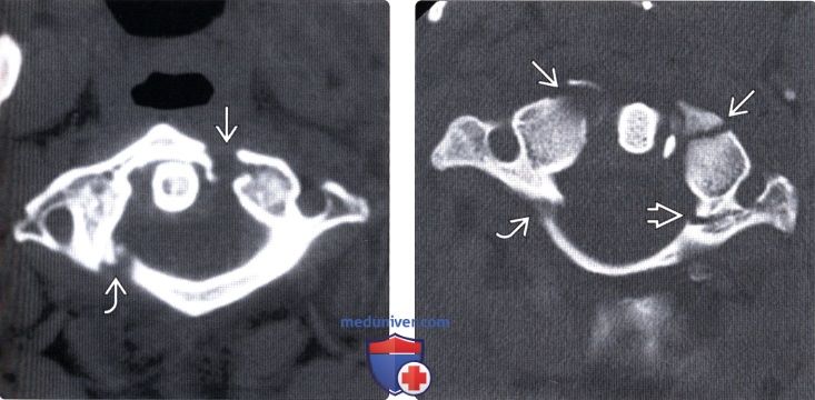 Рентгенограмма, КТ при переломе первого шейного позвонка (С1) Джефферсона
