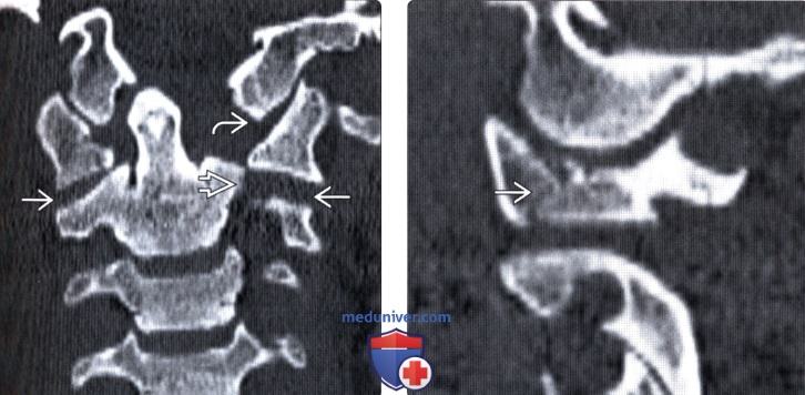 Рентгенограмма, КТ при переломе первого шейного позвонка (С1) Джефферсона