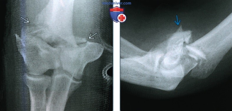 Признаки перелома дистального конца плечевой кости