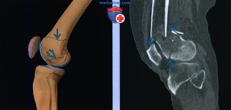 Признаки перелома дистального отдела бедренной кости