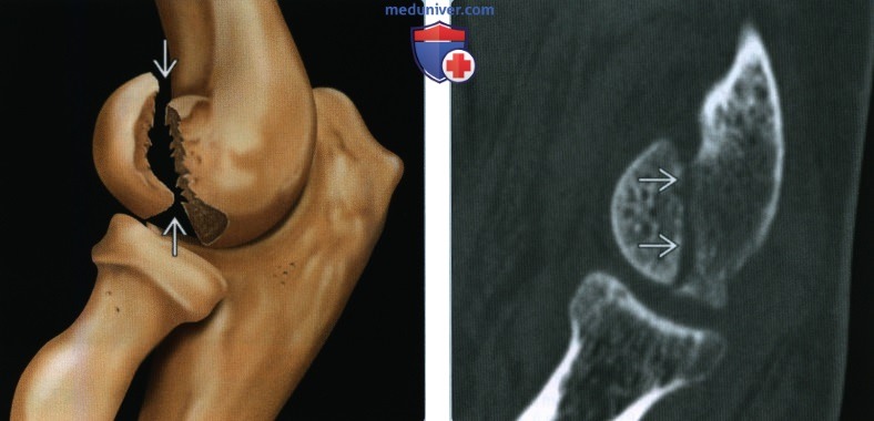 Признаки перелома головки мыщелка плечевой кости