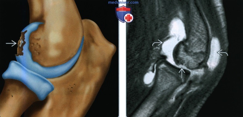 Признаки перелома головки мыщелка плечевой кости