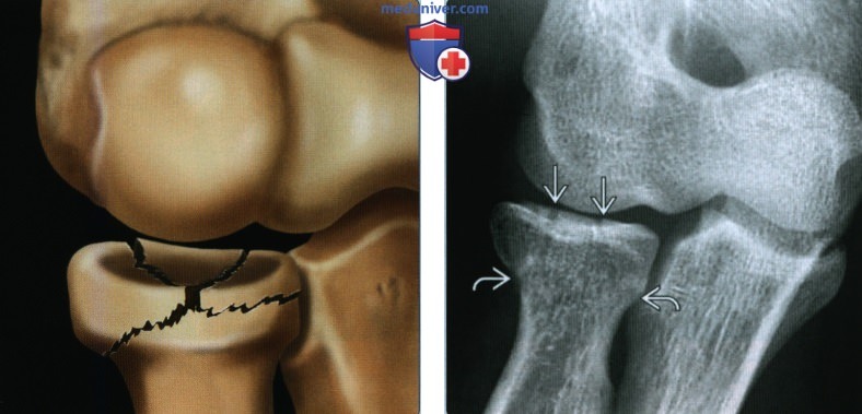 Признаки перелома головки и/или шейки лучевой кости