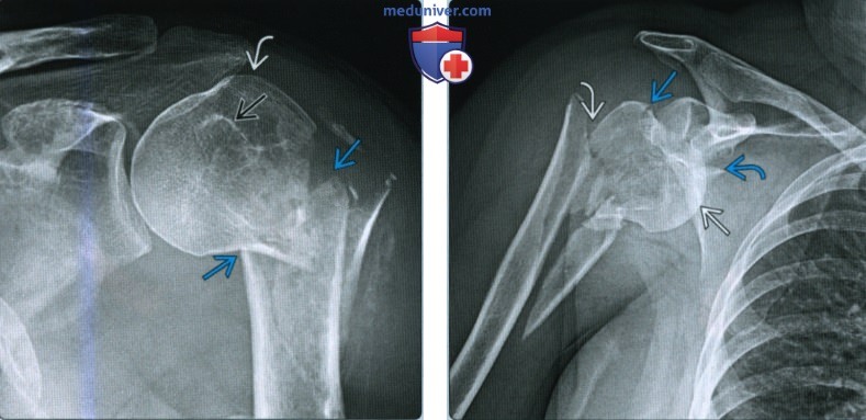 Признаки перелома головки и шейки плечевой кости
