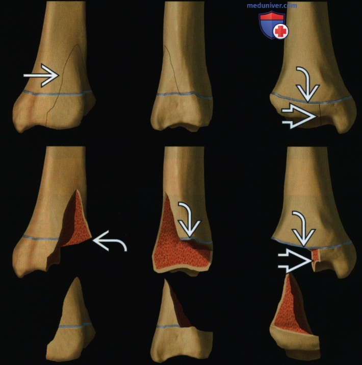 Признаки перелома костей голеностопного сустава по Салтеру-Харрису