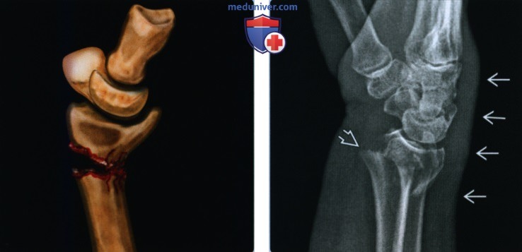 Признаки перелома дистального эпиметафиза лучевой кости (перелома луча в типичном месте)