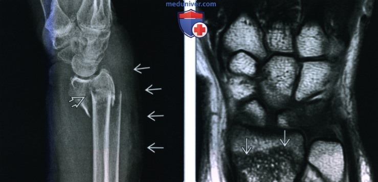 Признаки перелома дистального эпиметафиза лучевой кости (перелома луча в типичном месте)