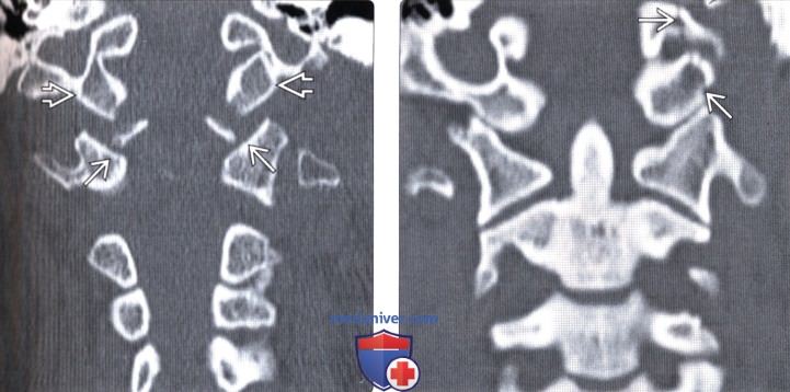 КТ, МРТ перелома мыщелка затылочной кости