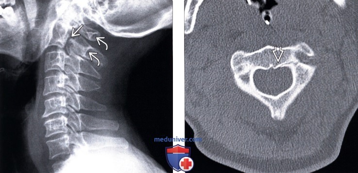 Рентгенограмма, КТ, МРТ перелома палача