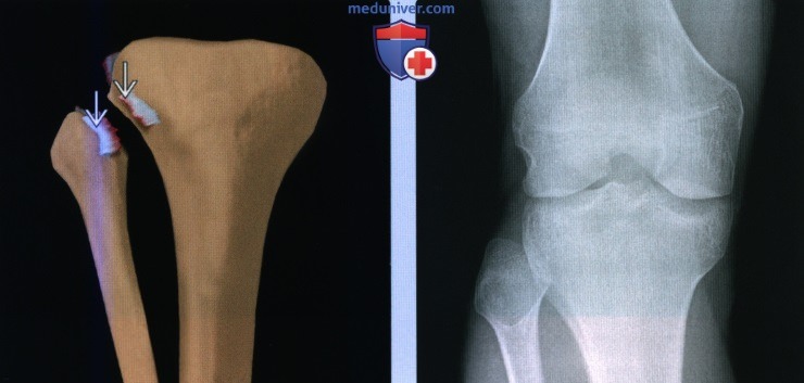Признаки перелома проксимального большеберцово-малоберцового сустава и проксимального отдела малоберцовой кости