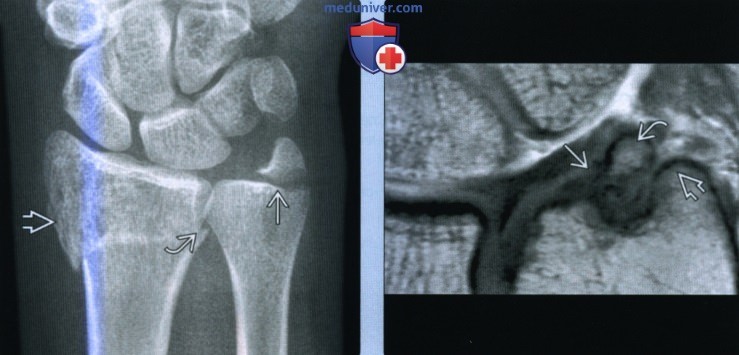Признаки перелома шиловидного отростка локтевой кости