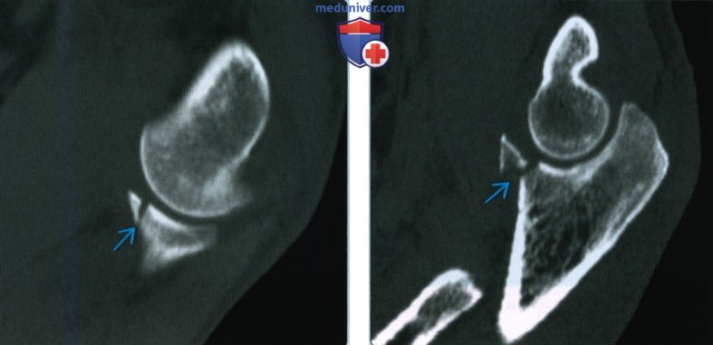 Признаки перелома венечного отростка локтевой кости