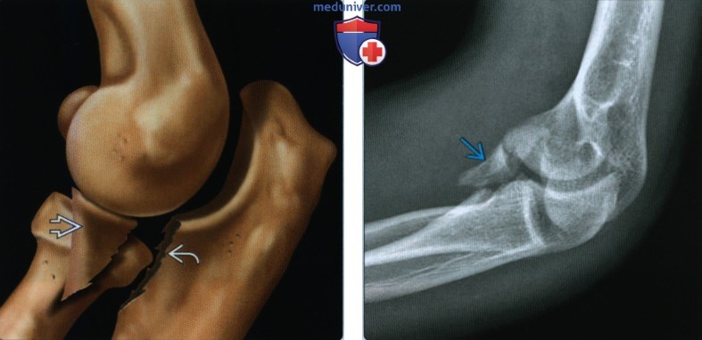 Признаки перелома венечного отростка локтевой кости