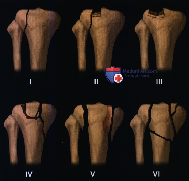 Признаки перелома верхней суставной поверхности большеберцовой кости