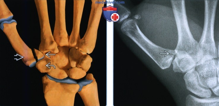Признаки перелома и вывиха пястной кости