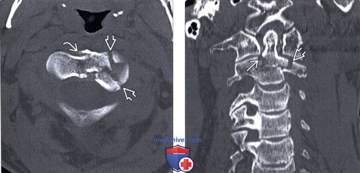 Рентгенограмма, КТ перелома зубовидного отростка второго шейного позвонка (С2)