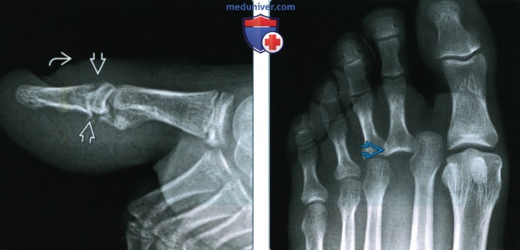 Признаки переломов и вывихов пальцев стопы