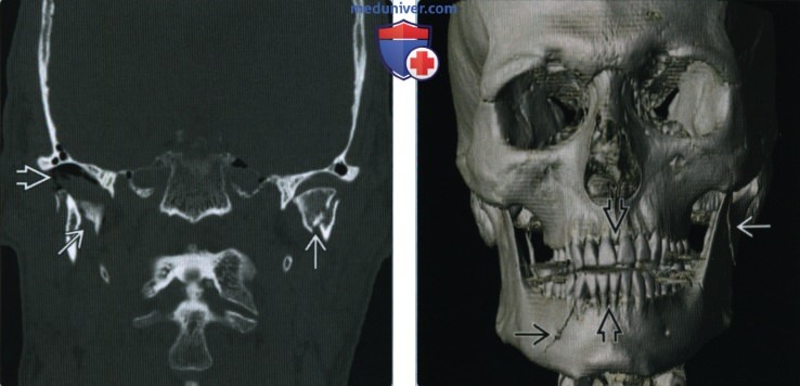 Переломы нижней челюсти - лучевая диагностика