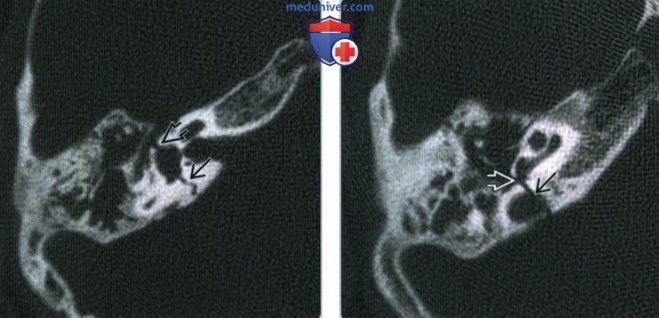 Переломы височной кости - лучевая диагностика