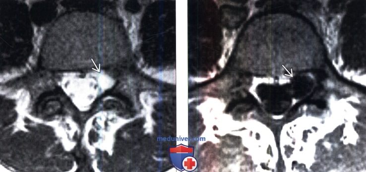 КТ, МРТ при периневральной кисте дуральной воронки