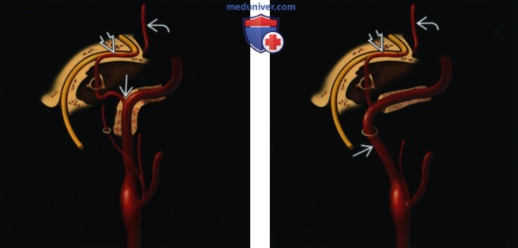 Персистирующая стременная артерия - лучевая диагностика