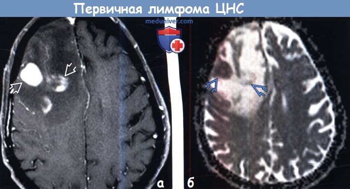 Первичная лимфома ЦНС на МРТ