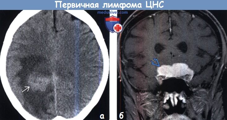 Первичная лимфома ЦНС на МРТ