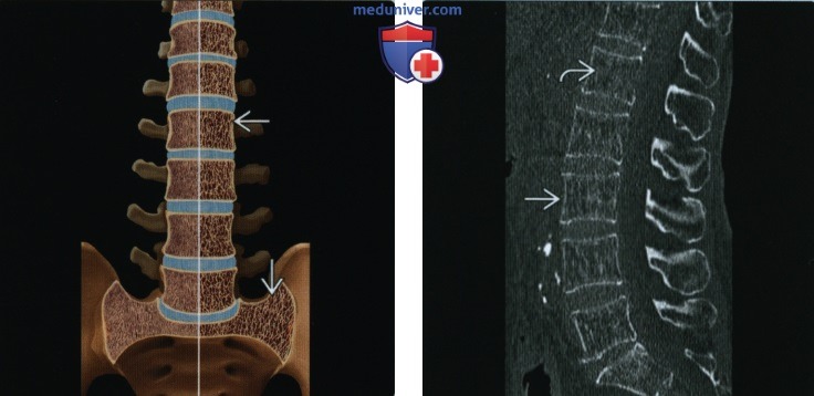 Первичный остеопороз - лучевая диагностика