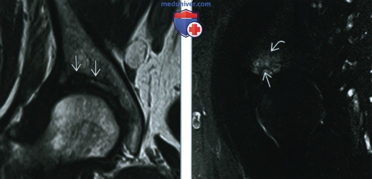 Первичный остеопороз - лучевая диагностика