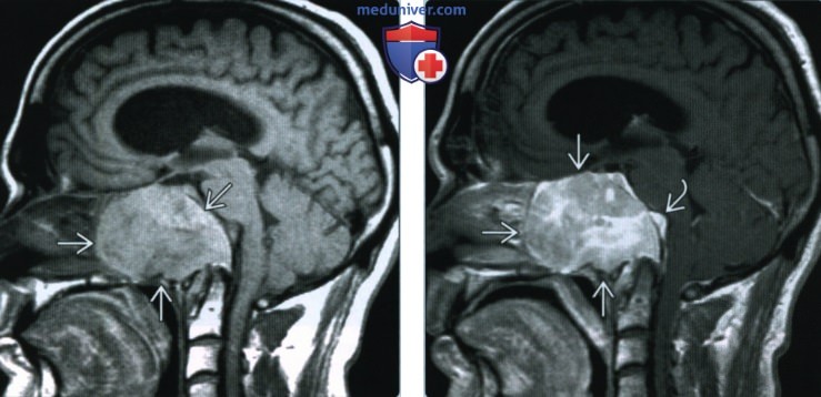 Плазмоцитома основания черепа - лучевая диагностика