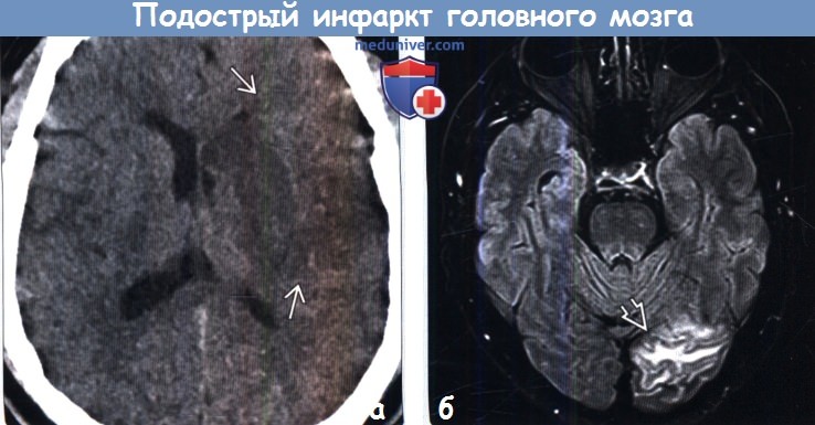 Подострый инфаркт головного мозга на КТ, МРТ