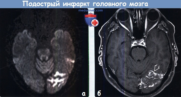 Пример МРТ при подостром инфаркте головного мозга