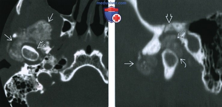 Поражение височно-нижнечелюстного сустава (ВНЧС) при болезни депонирования пирофосфата кальция дигидрата - лучевая диагностика