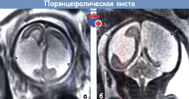 Порэнцефалия головного мозга на мрт thumbnail