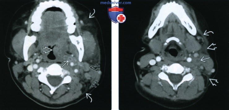Постангинальный венозный тромбоз (Лемьера) - лучевая диагностика