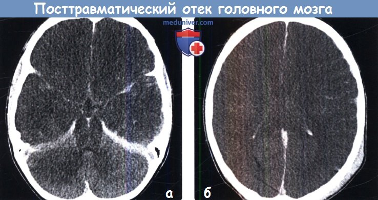 Посттравматический отек головного мозга на КТ