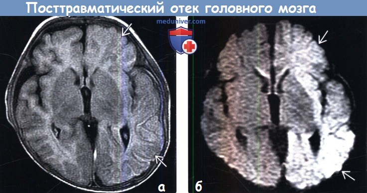 Посттравматический отек головного мозга на МРТ