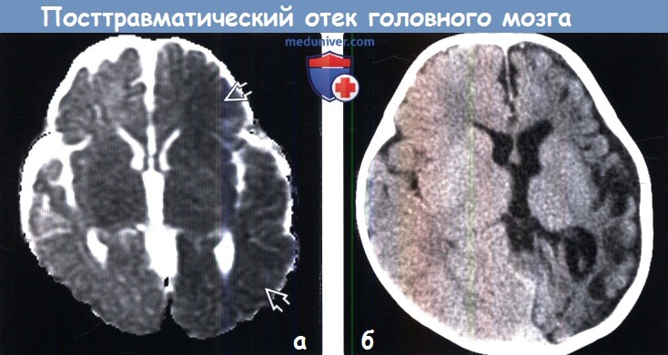 Посттравматический отек головного мозга на КТ, МРТ