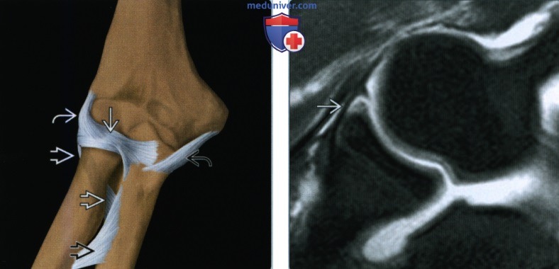Признаки повреждения кольцевой связки локтевого сустава