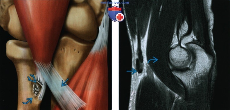 Признаки повреждения сухожилия двуглавой мышцы на уровне локтевого сустава